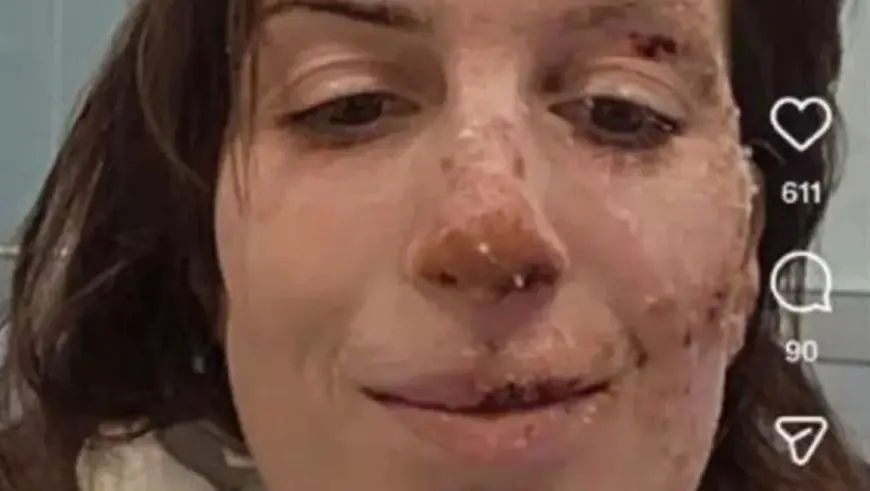 ELEONORA JE PREŽIVJELA POŽAR U ŠVICARSKOM SKIJALIŠTU, OBJAVILA SLIKE IZ BOLNICE: REKLA JE KAKO SE SPASILA